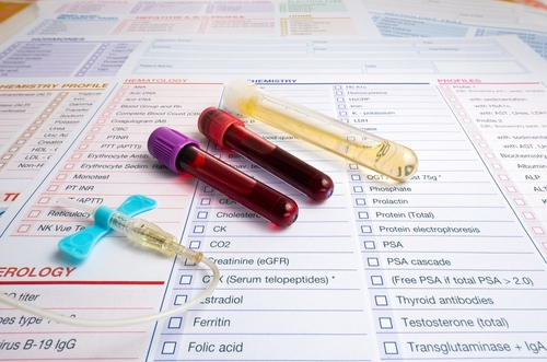 Several blood collection tubes are positioned on a medical form. The tubes contain various coloured liquids; some are red-coloured and appear full, while one is a pale, yellowish-tan colour. A light-blue collection device (likely for drawing venous blood) is attached to a clear plastic tube. The medical form has pre-printed sections and various checkboxes corresponding to different blood tests, such as chemistry profile, haematology, and serology. The form has a variety of test names printed in text headings and individual test names. Visible test names include "Chemistry Profile", "Haematology", "Serology", PTT, APTT, Erythrocyte Sedimentation Rate, PT INR, Reticulocyte, NK Vue Test, Cholesterol, CK, CO2, Creatinine, oestradiol, Ferritin, Folic Acid, Prolactin, Protein (Total), PSA, Thyroid Antibodies, Testosterone, and Transglutaminase + IgA. The background is primarily white paper.